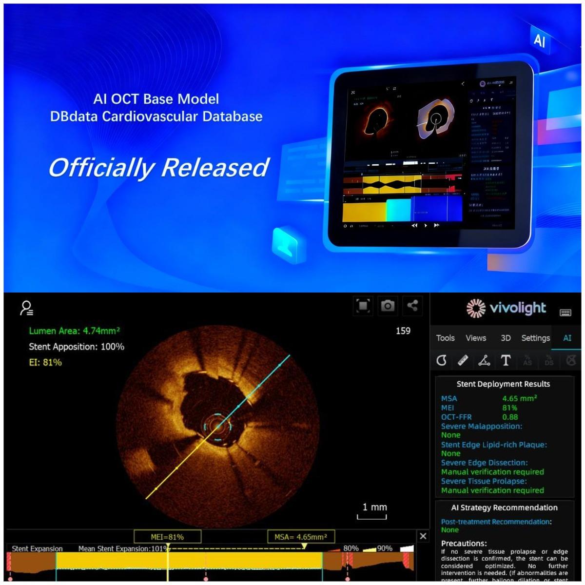 Nous ne suivons pas, nous créons ! L'imagerie intravasculaire chinoise entre dans son ère « DeepSeek » : Vivolight Medical lance son système AI-OCT.